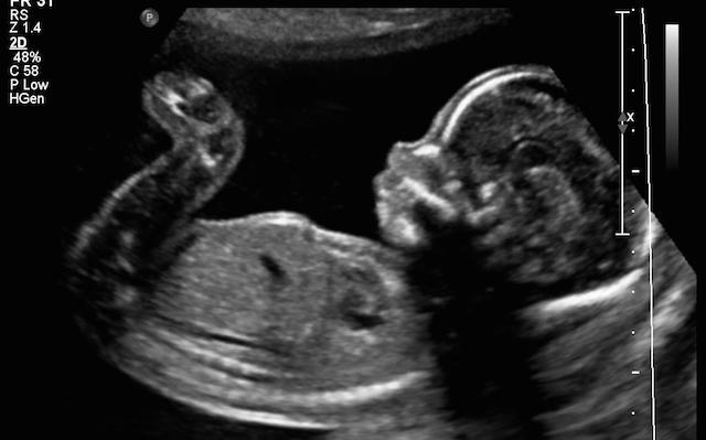 ultrasound photoshopped
